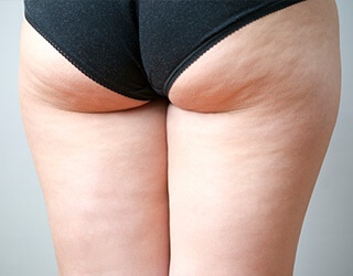 cellulite