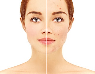 image of before & after acne