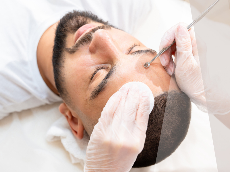 Acne Treatment - Aesthetics Lab - London