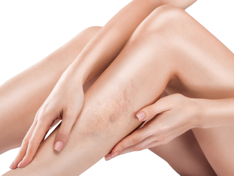 Microsclerotherapy treatment at Aesthetics Lab