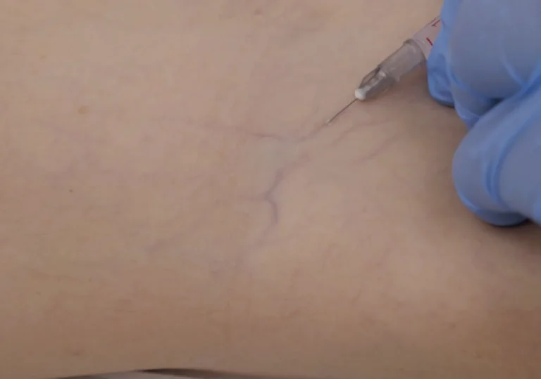 Microsclerotherapy thread vein treatment at Aesthetics Lab London