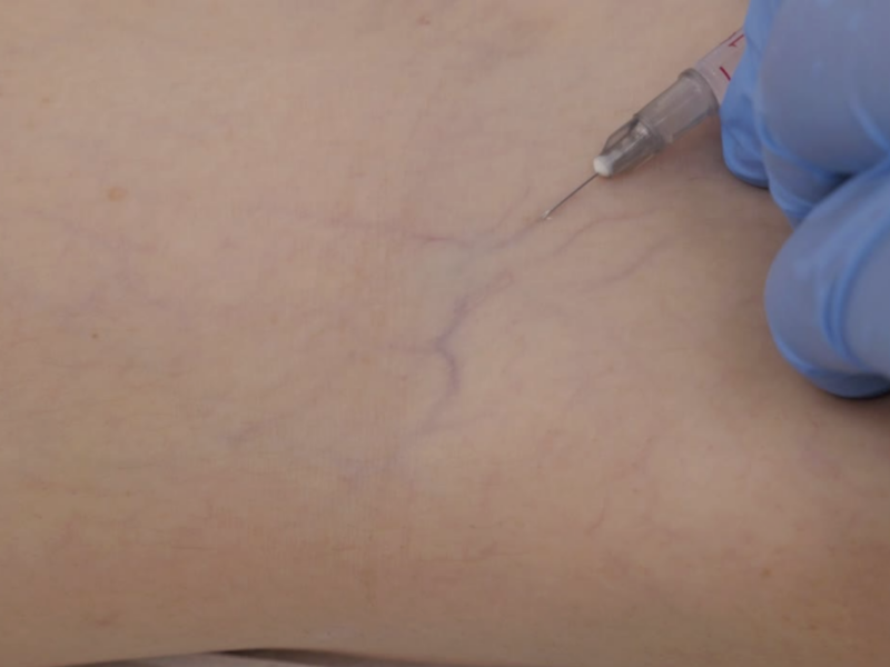 Microsclerotherapy thread vein treatment at Aesthetics Lab London