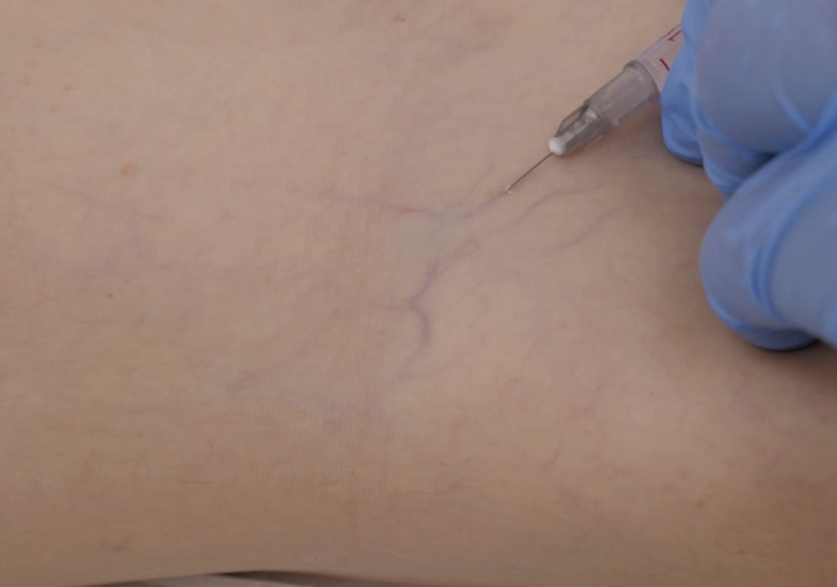 Microsclerotherapy thread vein treatment at Aesthetics Lab London