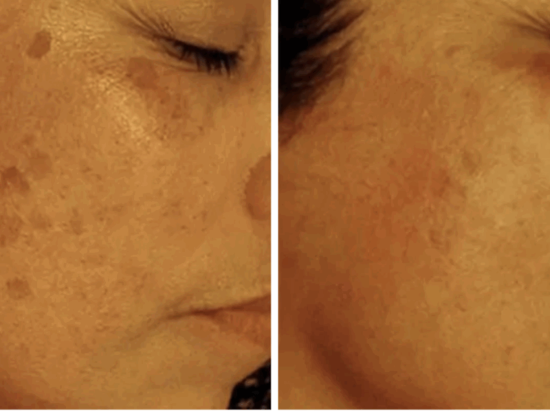 Post-Summer Pigmentation