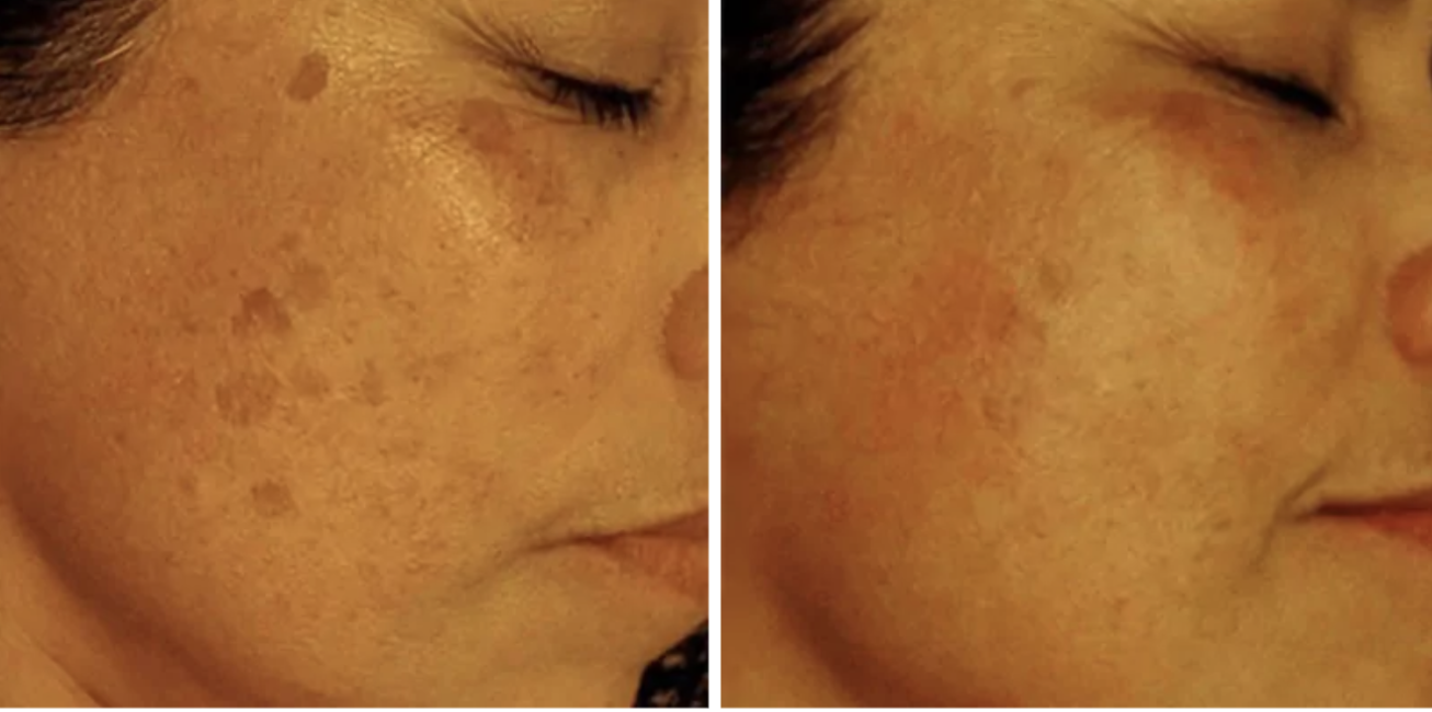 Post-Summer Pigmentation