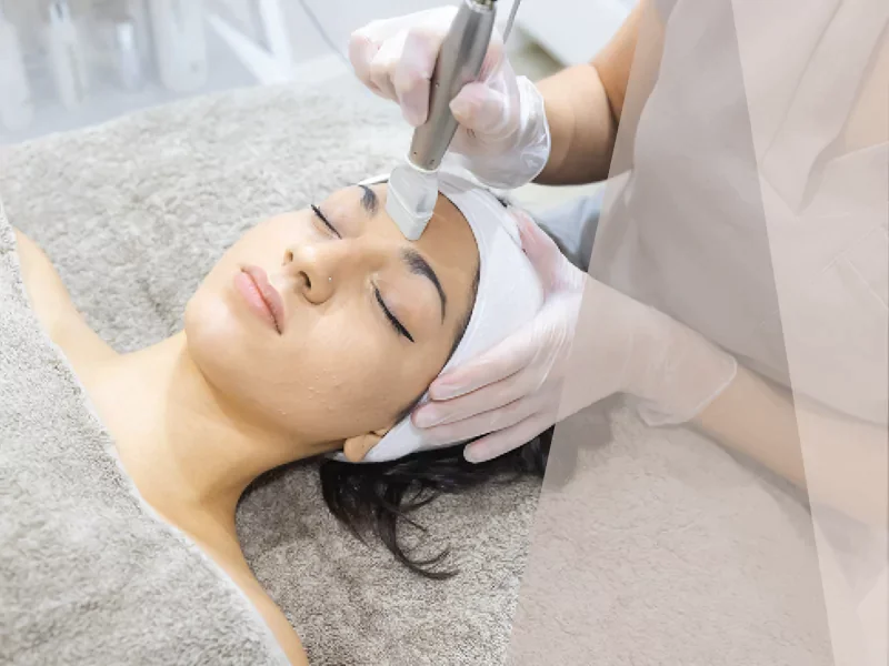 microneedling