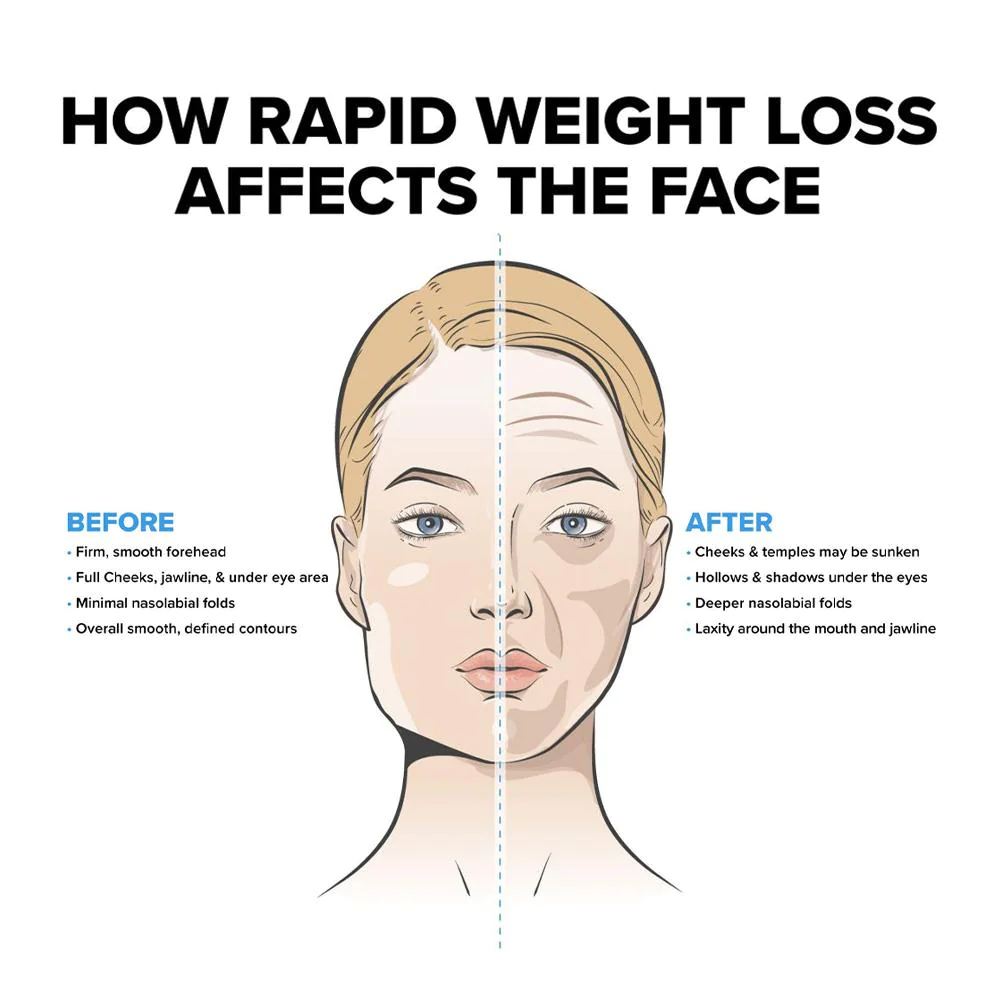 How rapid weight loss affects the face